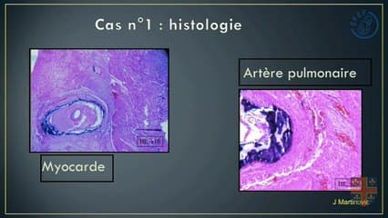 47 Le foetus n'a pas forcément l'âge de ses artères"
