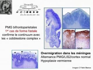 Devenir neurologique des anomalies corticales dépistées en anténatal