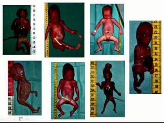 Quid de l'autopsie dans les IMG