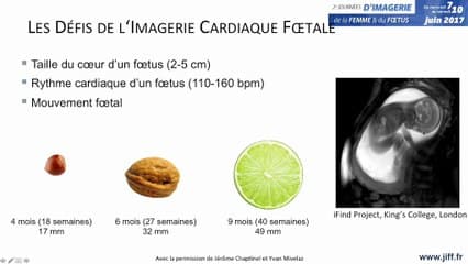 Coeur : IRM cardiaque