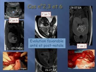 Le volvulus intestinal en IRM anténatale : silence, ça tourne ...