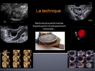 Les ovaires en écho