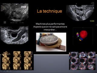 Les ovaires en écho