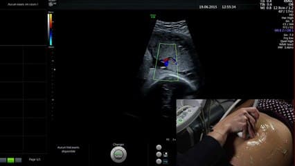 Démonstration live : Localisation placentaire et recherche de vaisseaux prævia.