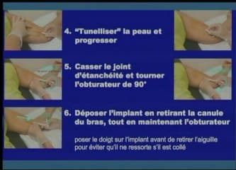 Flash Essure et Implanon : Place de l’échographie