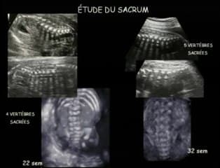 Les malformations anorectales
