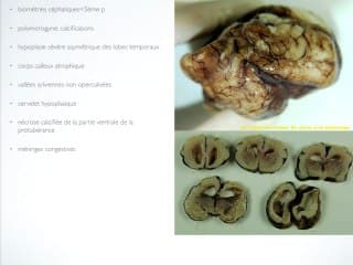 Foetopathie infectieuse avec atteinte cérébrale ( non CMV )