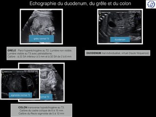 POSTER Duodenum Grele Colon