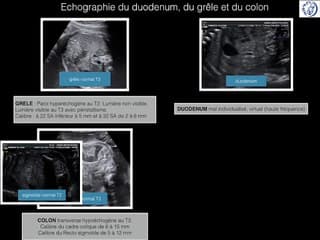 POSTER Duodenum Grele Colon