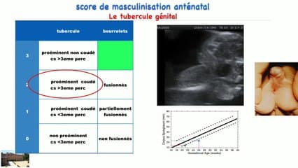 Faisabilité des items échographiques prénataux nécessaire à l’établissement d’un score de masculinisation anténatal (étude préliminaire).