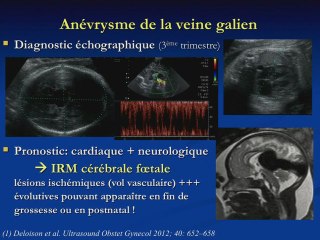 Hémorragies intracérébrales tardives, AVC et veine de Galien.