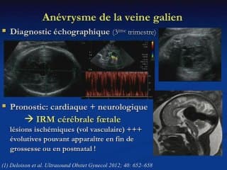 Hémorragies intracérébrales tardives, AVC et veine de Galien.