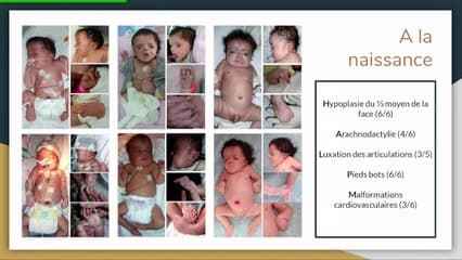 Phénotype de la mutation B3GAT3 : à propos de 4 familles