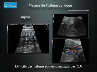Les anomalies cardiaques à révélation tardive au 3eme trimestre