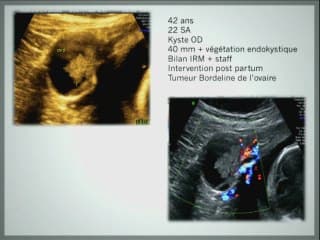 ovaire maternel et grossesse