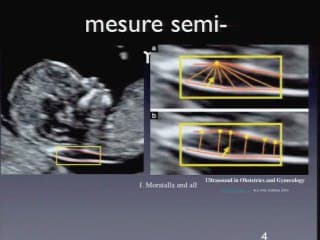 Optimiser les examens de dépistage