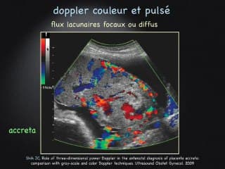 Diagnostic échographique des placentas accretas
