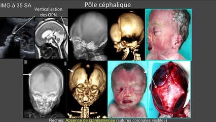 Corrélations Echographie-Foetopathologie : syndrome de PFEIFFER, syndrome d' APERT, Syndrome d' ANTLEY BIXLER