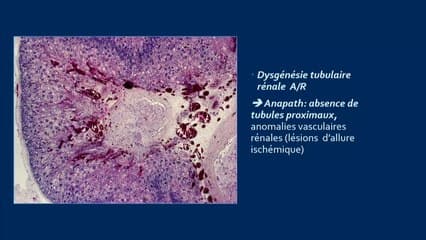 Les reins hyperéchogène, une fois les polykystoses exclues