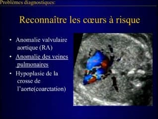 Petit coeur gauche : cardiopathie grave ou coeur normal ?