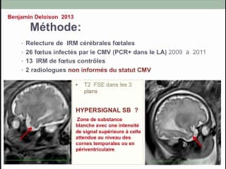 CMV : Apport de L'IRM dans la surveillance des infections a_ CMV