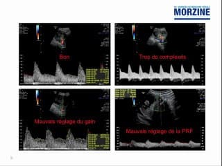 Techniques et intér'ts du Doppler utérin au 1er trimestre