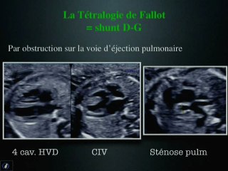 Cardiopathie cyanogène