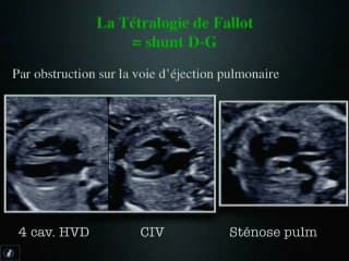 Cardiopathie cyanogène
