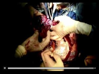 Tumeurs foetales : Prise en charge in utero, pronostic des tératomes sacro-coccygiens