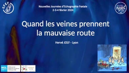 Coeur foetal : quand les veines prennent la mauvaise route