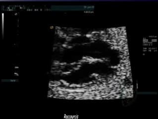 La croix du cœur (protocole)