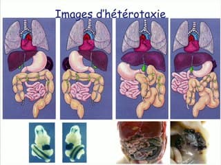 Un an de littérature utile à la pratique Coeur : de l'image à la génétique analyse clonale tete et c?ur, RASopathies, BOURNEVILLE, CAV