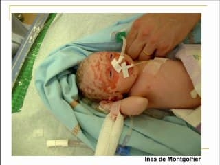 Grossesse chez la femme lupique