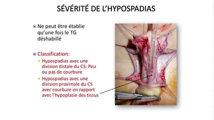 anomalies des organes génitaux :évaluation phénotypique des organes génitaux des anomalies du développement génito-sexuel (dsd), traitements chirurgicaux