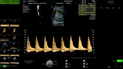 PAG et RCIU on demand : repérer les sites dopplers