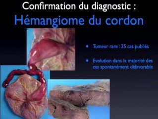 Tumeur du cordon