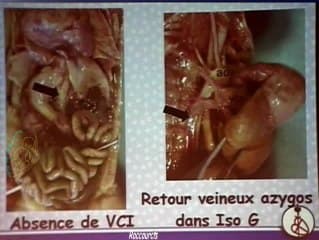 Les signes d'appels des hétérotaxies (échographie)