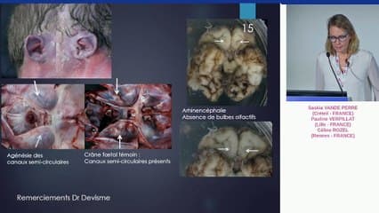 Cas clinique en anté-natal et suivi post-natal, QUIZZ