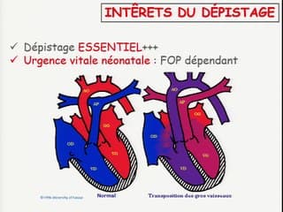 TGV Diagnostic : apport du cardiopédiatre