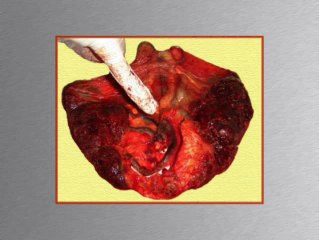 Insertion velamenteuse