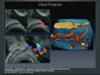 Cordons - membranes : images habituelles et images inhabituelles, Conséquences sur la prise en charge obstétricale