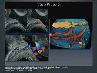 Cordons - membranes : images habituelles et images inhabituelles, Conséquences sur la prise en charge obstétricale