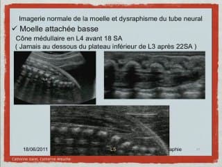 Imagerie normale de la moelle et dysraphisme du tube neural.
