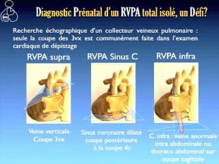 Le retour veineux pulmonaire anormal : ceinture et bretelles