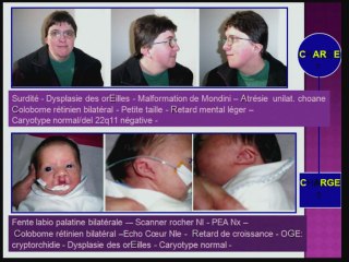 découverte d'une pathologie familiale par celle d' une anomalie foetal