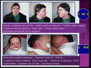 découverte d'une pathologie familiale par celle d' une anomalie foetal