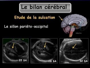 Conduite de l’examen échographique cérébral foetal lorsde la découverte d’une ventriculomégalie