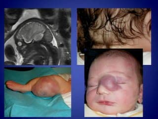 Tumeurs et pseudo-tumeurs de la face : à quoi faut-il penser ?