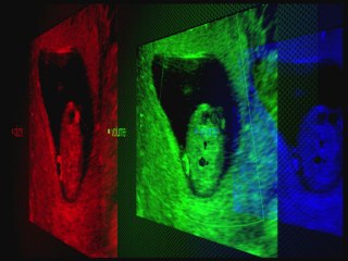 Les images liquidiennes abdominales de découverte précoce : qu'en penser ?