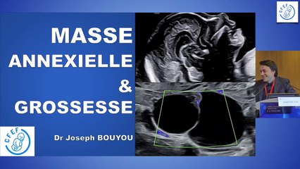 Masses annexielles et grossesse